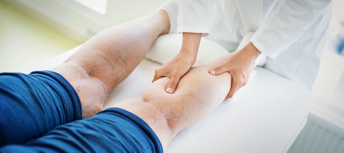 vene varicose sulle gambe e suo trattamento