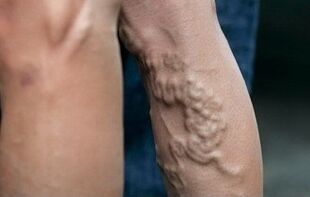 Vene varicose sulle gambe