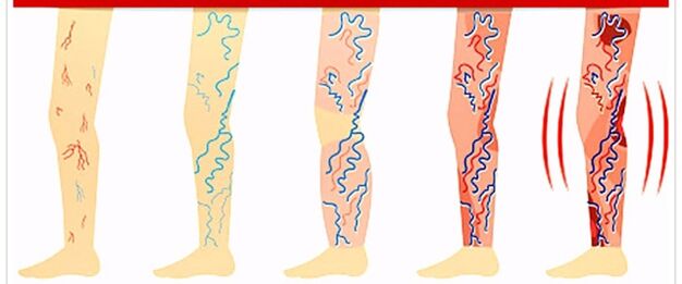 cosa non fare con le vene varicose
