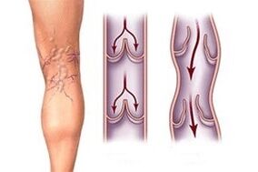 deflusso di sangue nelle vene varicose in diversi stadi di sviluppo della malattia